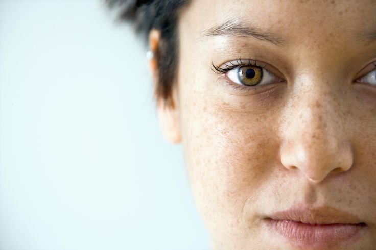 Gravidez e o Melasma – Cuidados com a pele