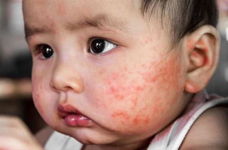 Crianças são as que mais sofrem com dermatite atópica