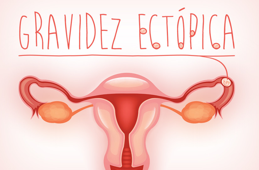 O que é Gravidez Ectópica? (causas, sintomas e tratamento)