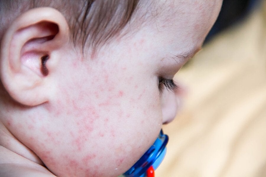 Alergia Alimentar: orientações sobre sintomas, diagnóstico e tratamento