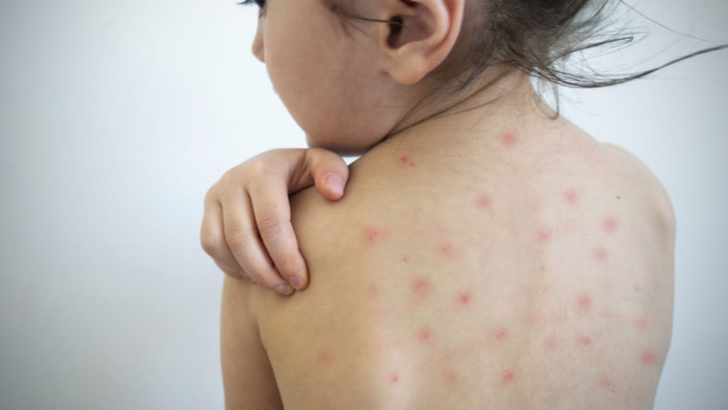 Alerta Sarampo: pediatra esclarece principais dúvidas sobre a doença