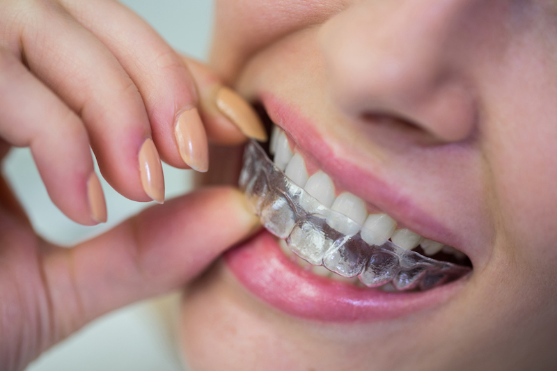 Aparelho ortodôntico transparente: Uma forma mais confortável das crianças tratarem seus dentes
