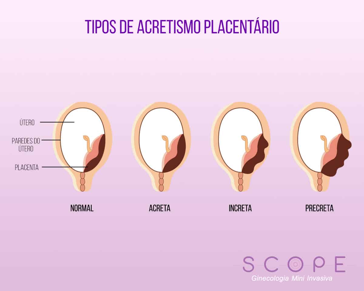 Acretismo